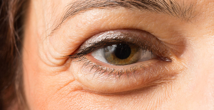 Everything you need to know about eye bags