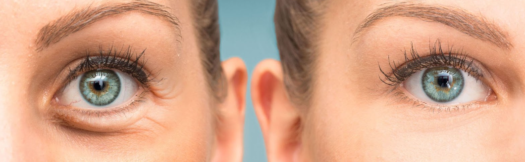 How do you remove eyebags naturally?