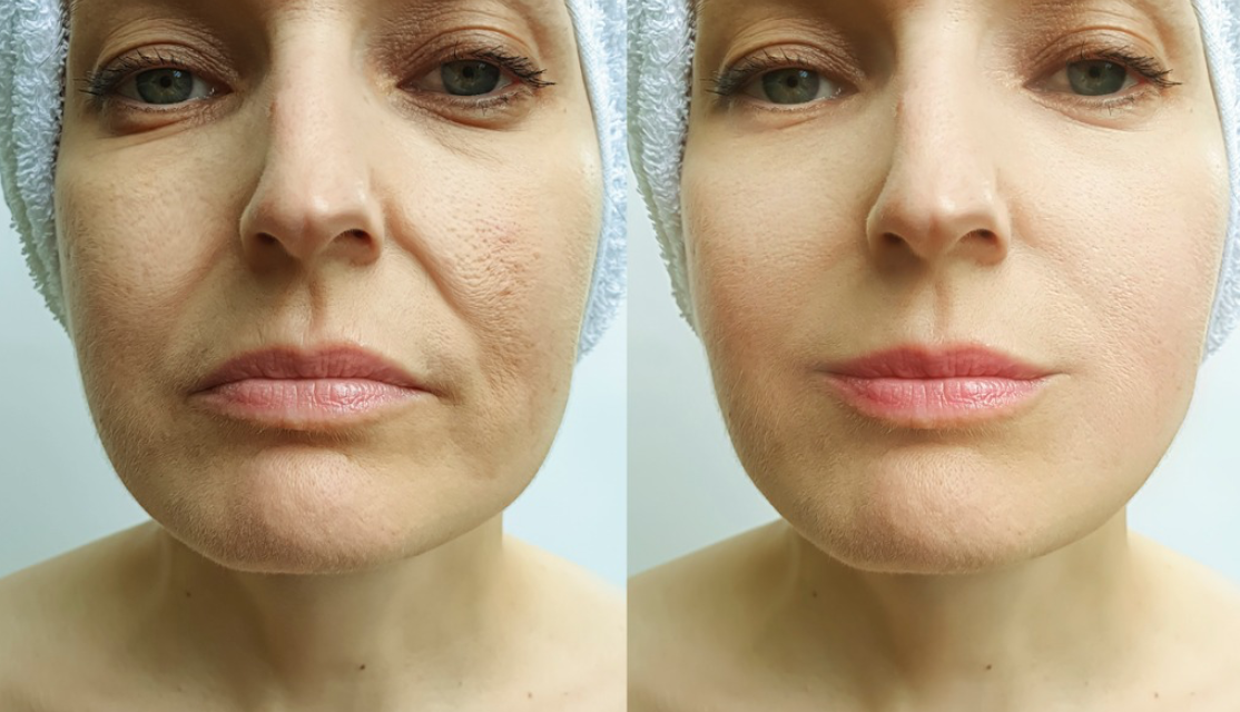 How to get rid of laughing lines naturally?