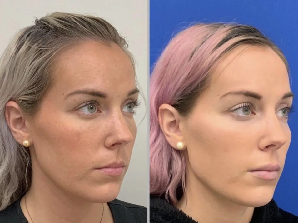 Laugh lines treatment before and after results 