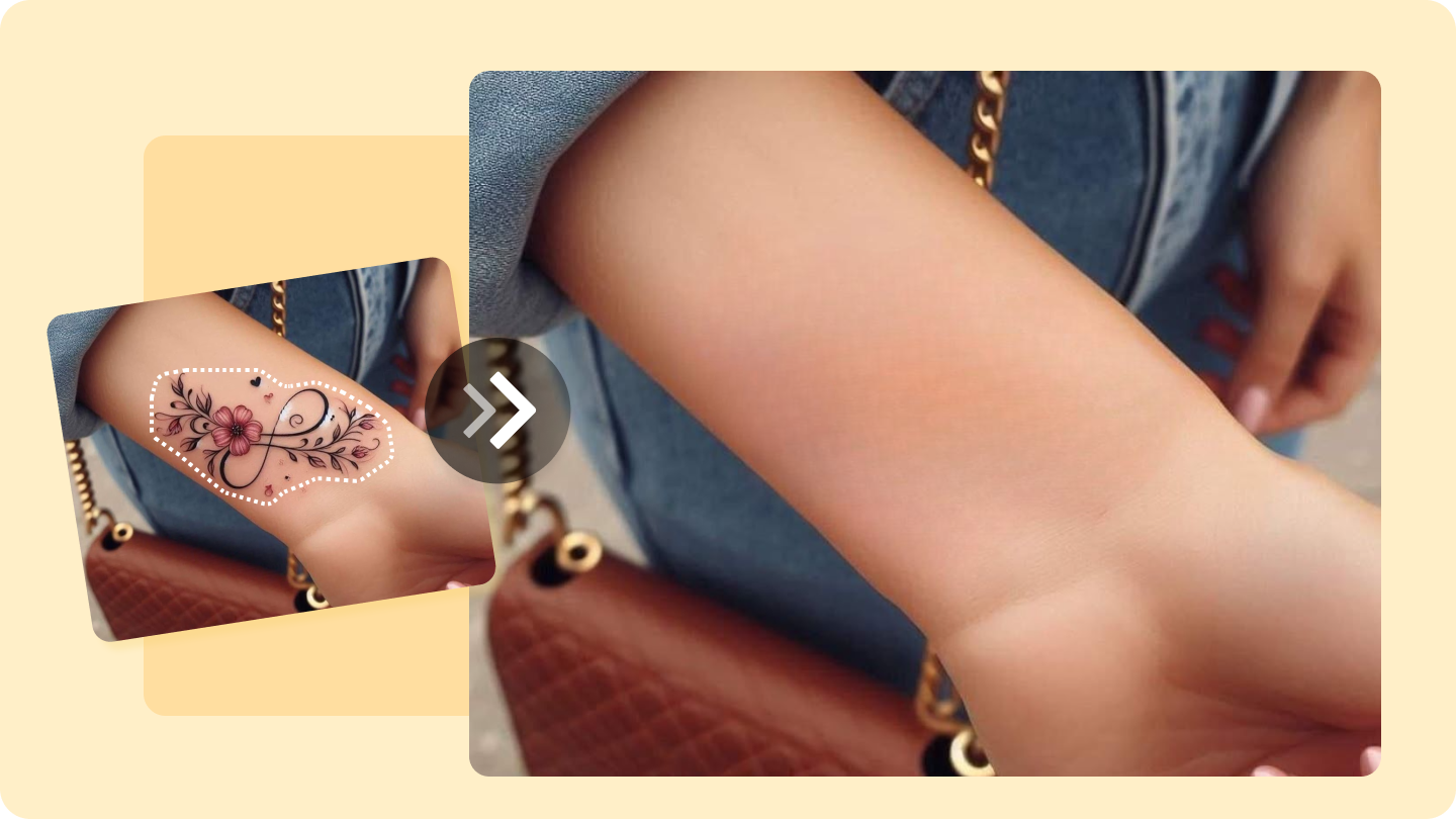 入れ墨の除去写真